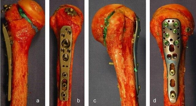 中国汽研获得发明专利授权:“一种仿人肋骨的胸部生物力学性能模拟模块及测量方法”