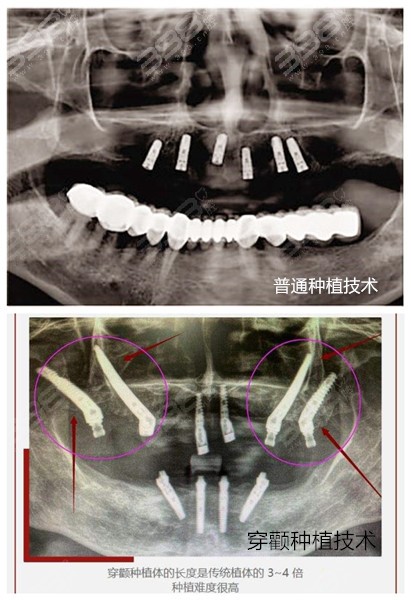 爱迪特：沃兰种植体已入选国内口腔种植体系统集中带量采购名单